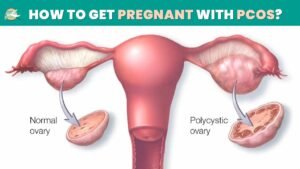 How to Get Pregnant with PCOS