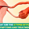 What are the 4 types of PCOS: Symptoms and Treatment